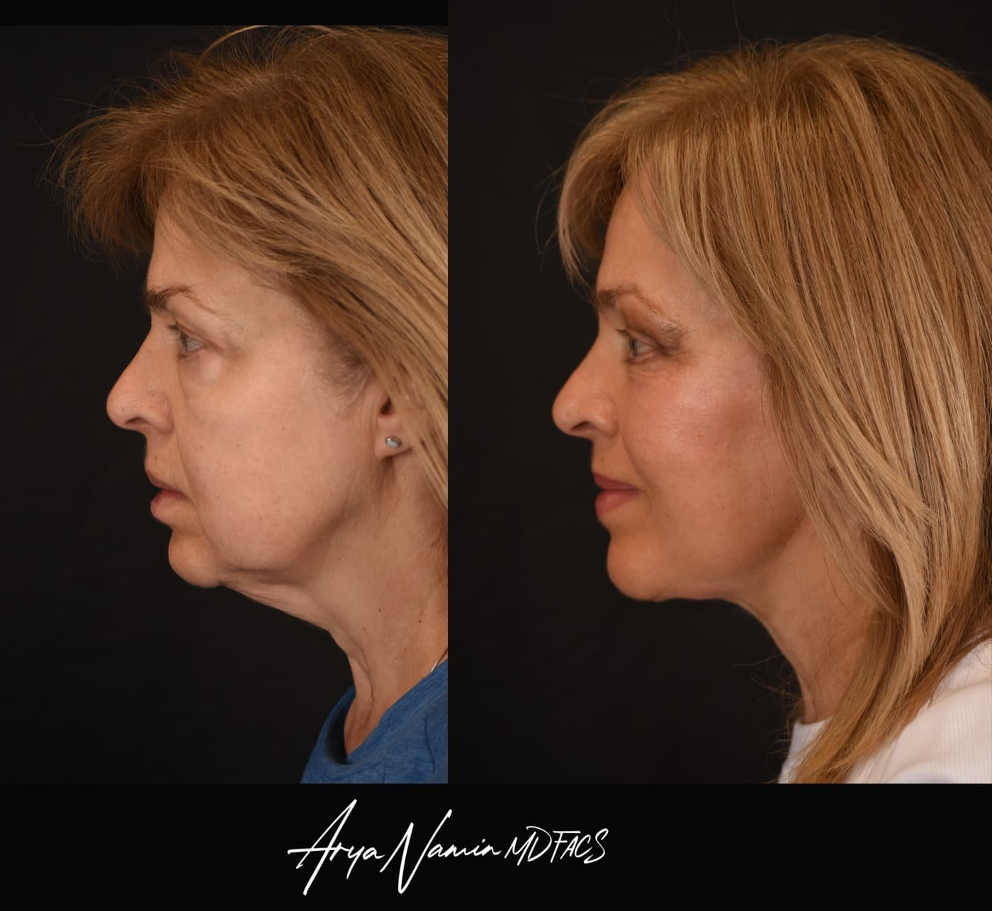 Deep plane facelift before and after, profile view