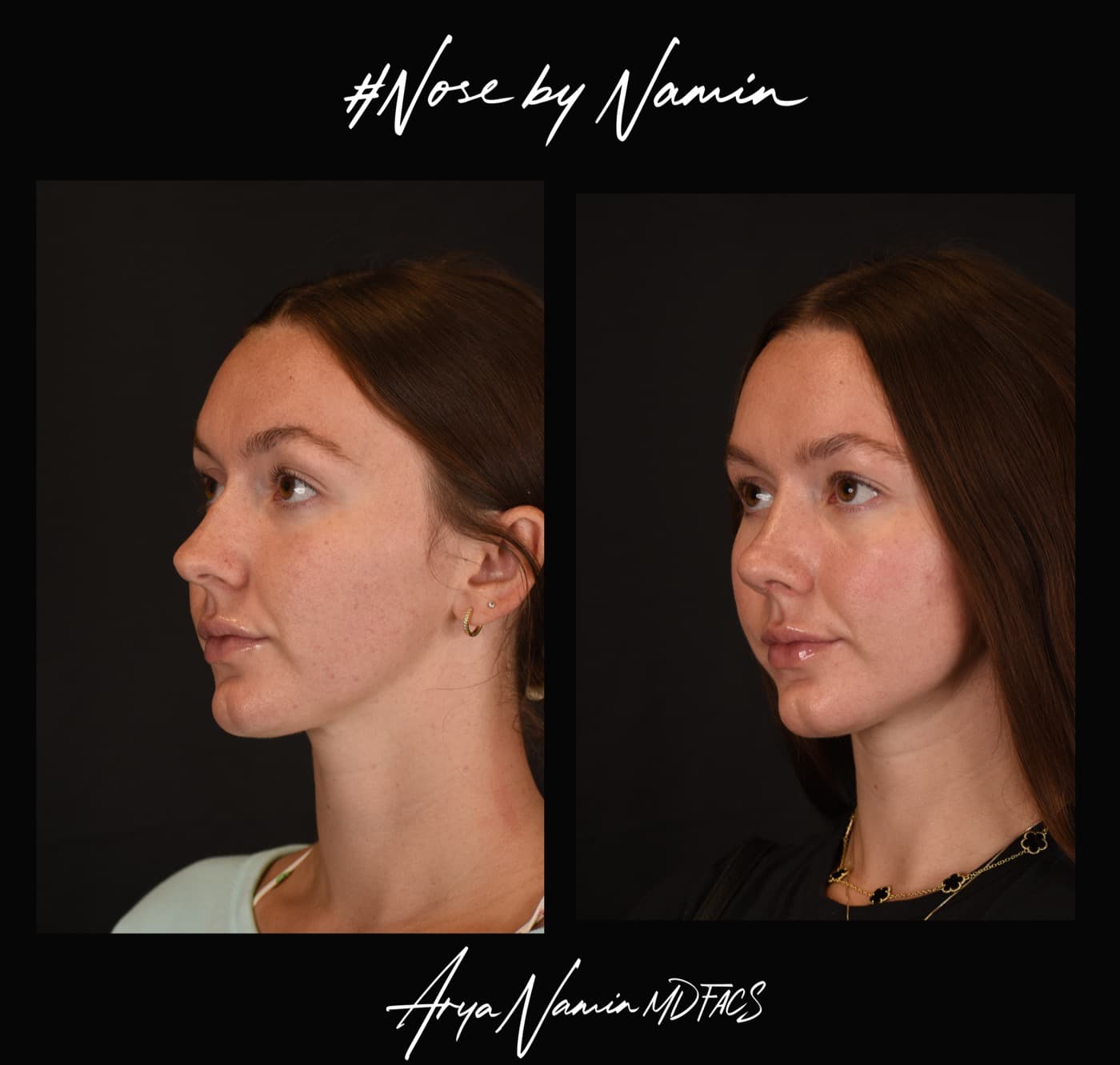 Rhinoplasty before and after, three-quarter view